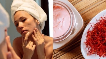 Women suffering acne scars