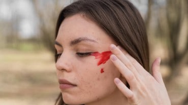 Vicarious menstruation
