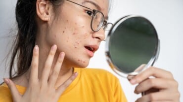 acne scars