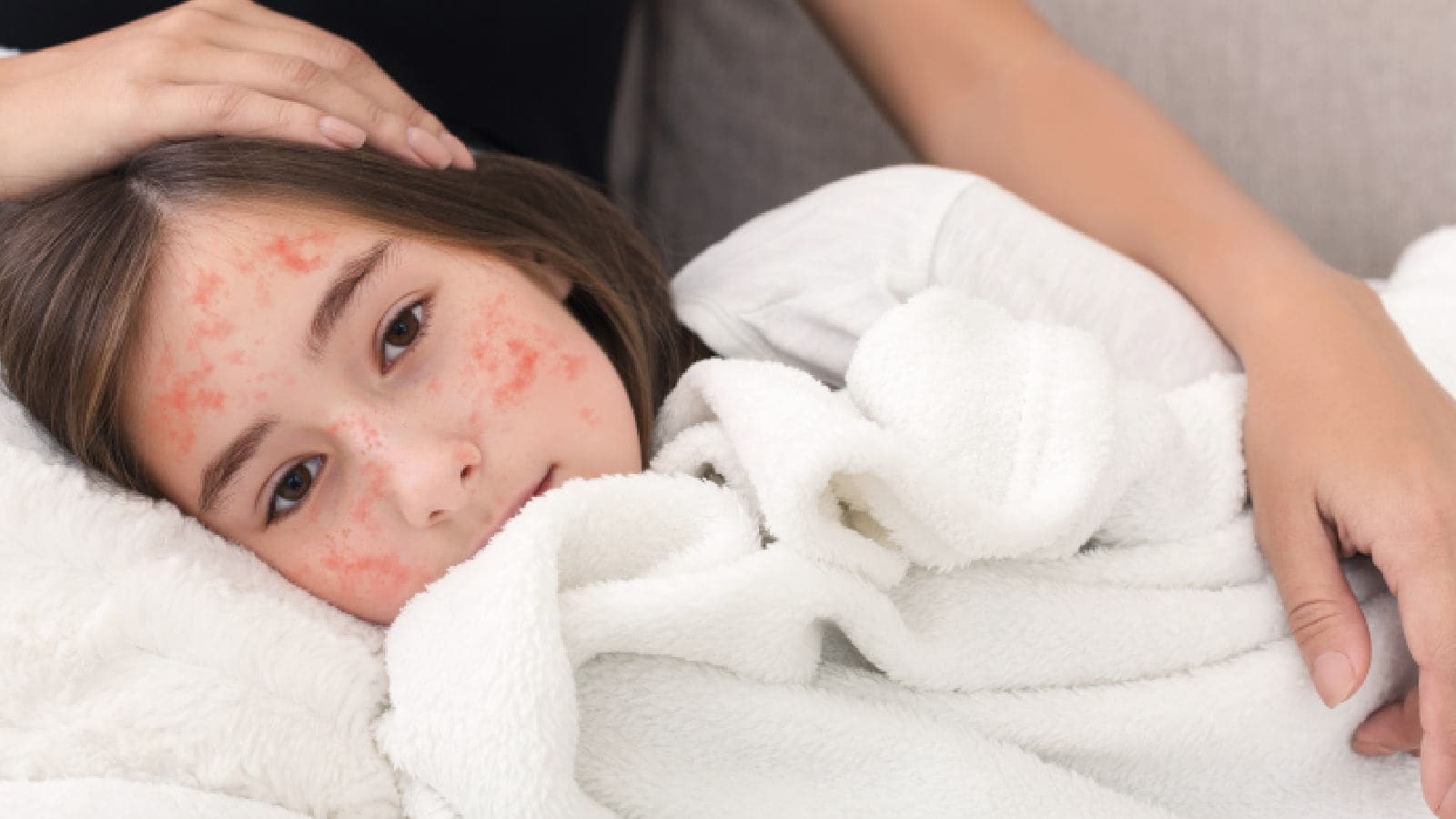 Measles outbreak