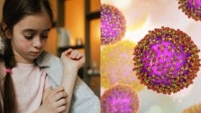 kid with measles symptoms and measles virus
