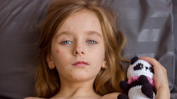 Measles outbreak