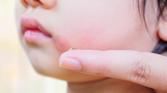 A child with slapped cheek disease